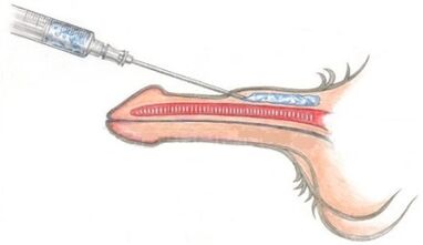 L'inserimento di materiali polimerici nel pene per ispessirlo